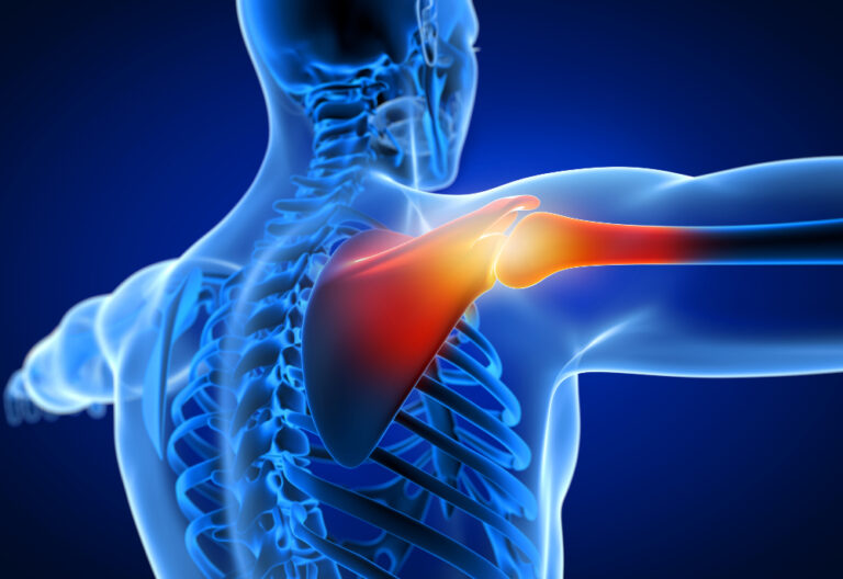 Shoulder Separation vs Shoulder Dislocation